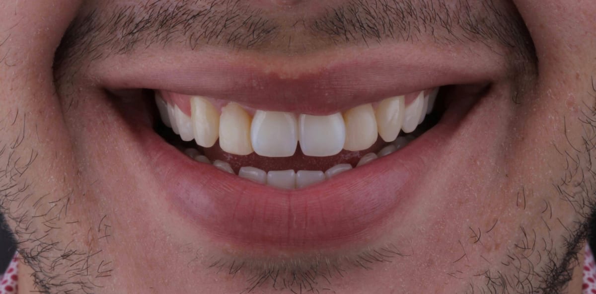 Antes: sonrisa con dientes amarillentos y desalineados