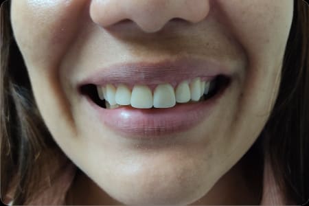Resultado final del diseño de sonrisa con carillas de porcelana