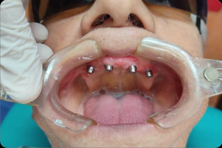 Estado inicial antes de colocar el implante dental