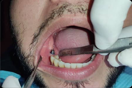 Estado inicial del segundo caso antes de colocar el implante dental