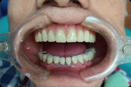 Resultado final del caso con implante dental en Implant Dental Guayaquil