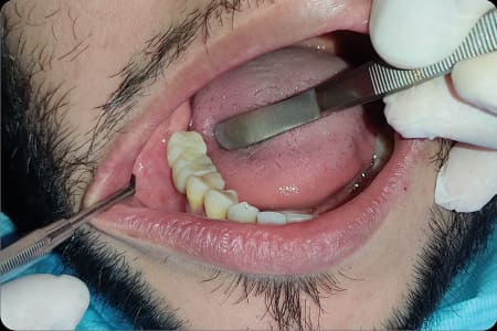 Resultado final del segundo caso con implante dental en Implant Dental Guayaquil