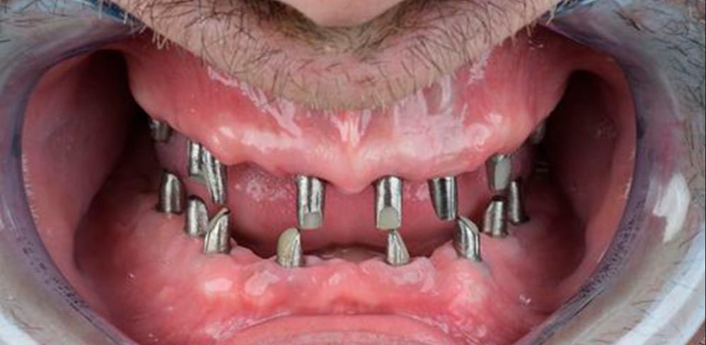 Antes: pilares sobre implantes antes de colocar la prótesis