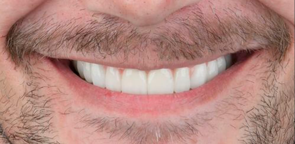 Después: dentadura fija terminada en paciente de Implant Dental Guayaquil