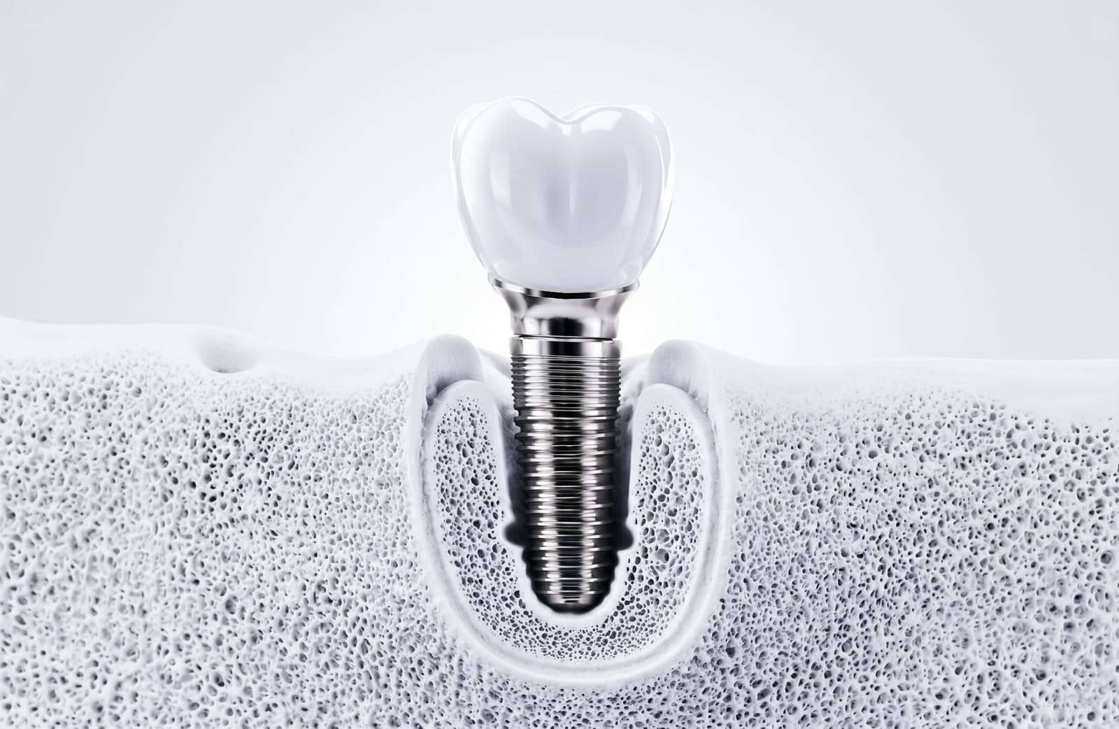 Implante dental con corona blanca, pilar y tornillo de titanio dentro de un corte de hueso trabecular