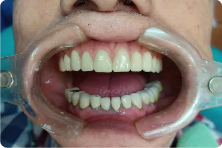 Resultado final de un caso All-on-4 en paciente de Implant Dental Guayaquil