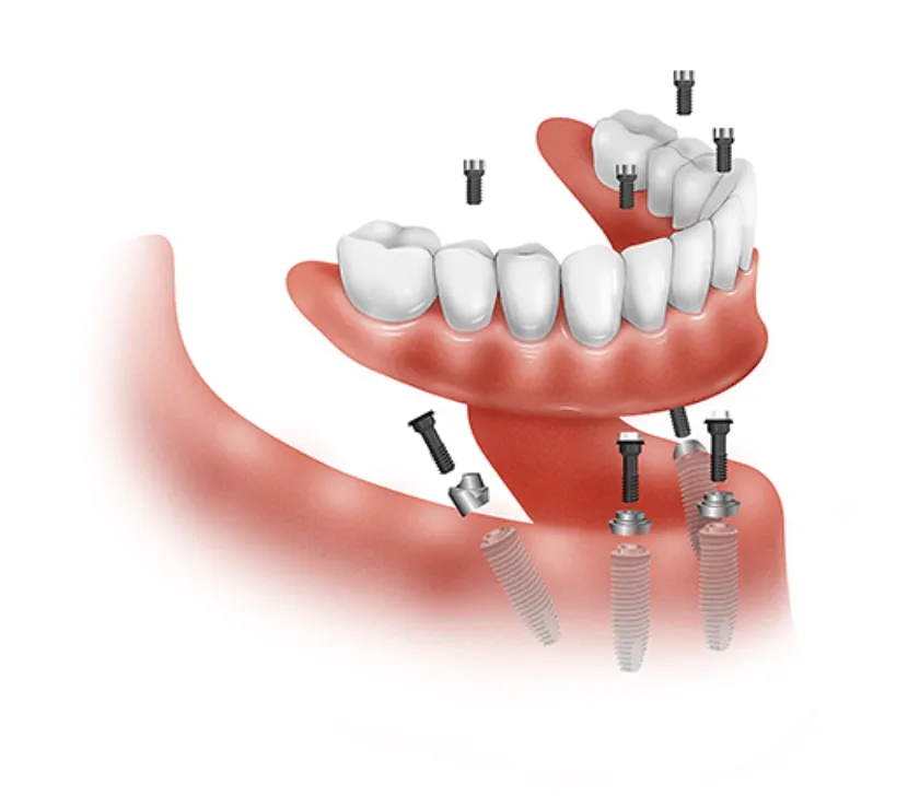 Prótesis dental fija completa sostenida por implantes con la técnica All-on-4